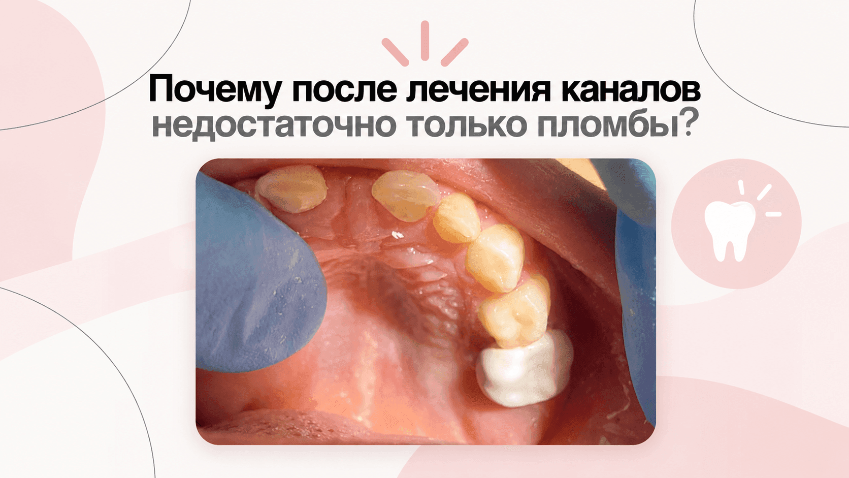 КЕЙС | КОРОНКА НА 55 ЗУБ ПОСЛЕ ПУЛЬПИТА